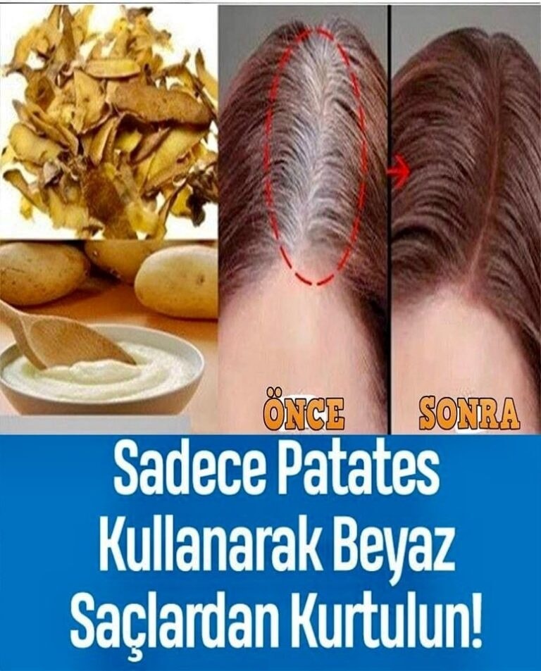Beyaz Saça Patates Kabuğu ile Son