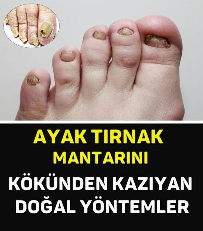 Tırnak mantarından kurtulmak için
