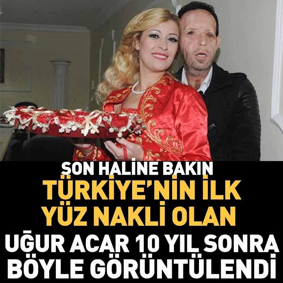Türkiye’de ilk yüz nakli yapılan isimlerdi
